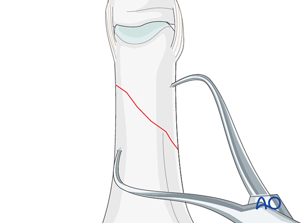 Direct reduction with two pointed-reduction forceps of an extraarticular oblique fracture of the proximal phalangeal head – hand.