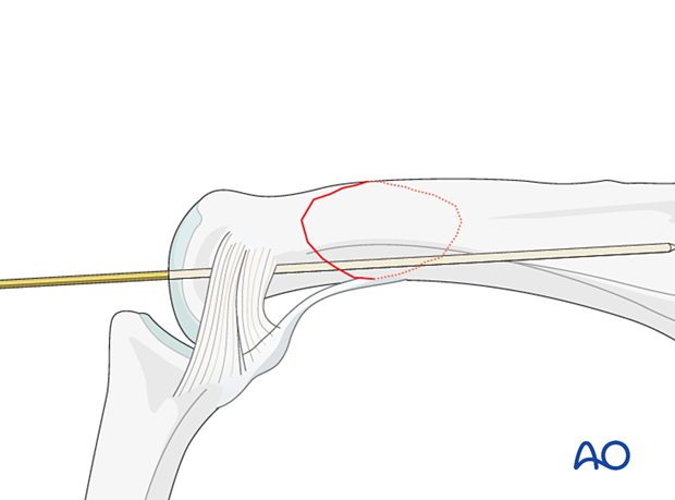 Preliminary fixation with a K-wire of an extraarticular oblique fracture of the proximal phalangeal head – hand.