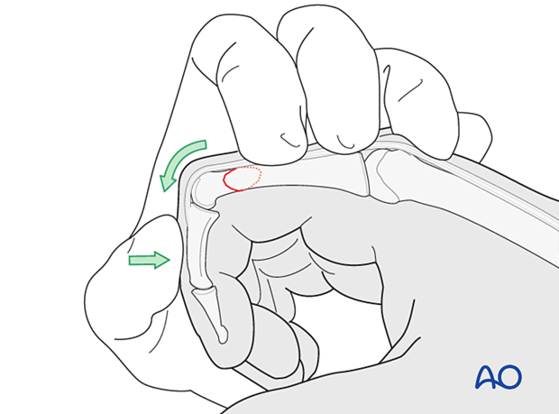 Reduction preliminarily held by an assistant holding the finger in flexion – extraarticular oblique fracture of the proximal phalangeal head – hand.