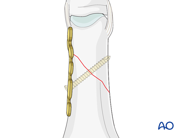 A lag screw inserted through the oblong hole and the middle of the fracture plane as perpendicular as possible to it – extraarticular oblique fracture of the proximal phalangeal head – hand.