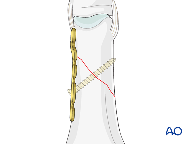 Lateral Compression Plate Compression with a lateral plate with or without lag screw for Oblique ...
