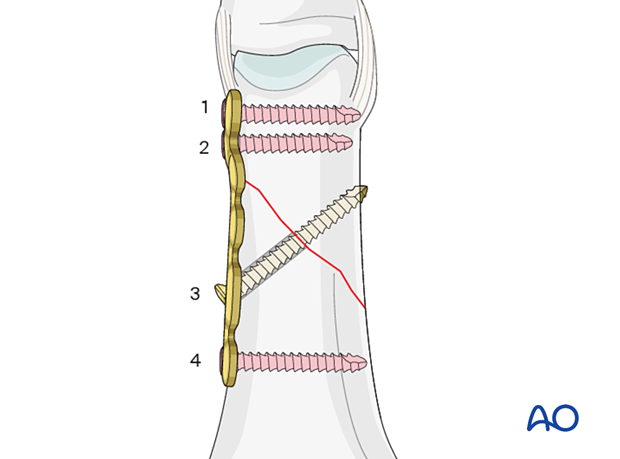 Order and placement of screws – lateral anatomical plate for an extraarticular oblique fracture of the proximal phalangeal head – hand.