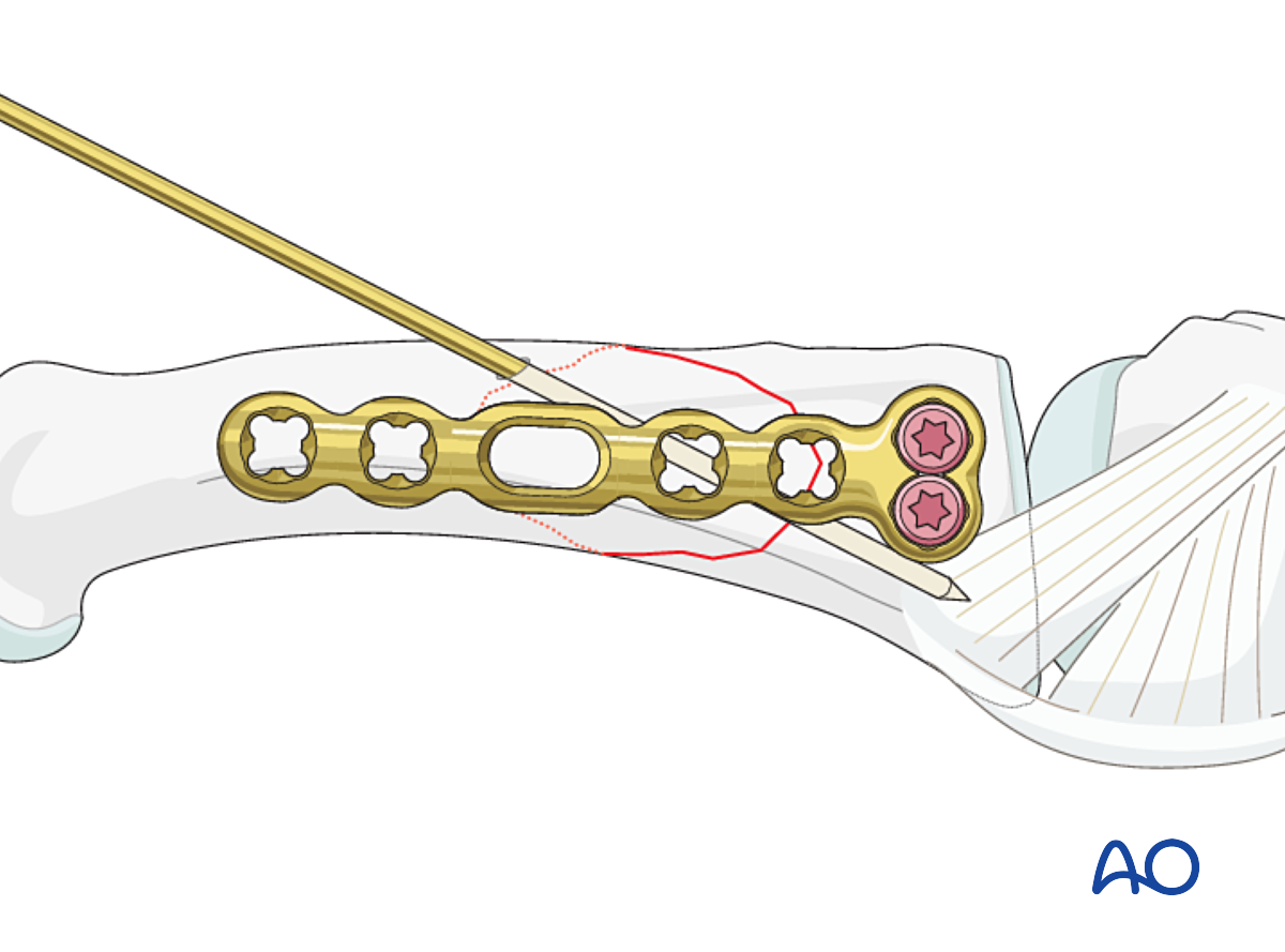 Compression With A Lateral Plate With Or Without Lag Screw For Oblique ...