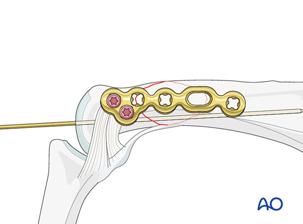 Two locking head screws in the articular block – lateral anatomical plate for an extraarticular oblique fracture of the proximal phalangeal head – hand.