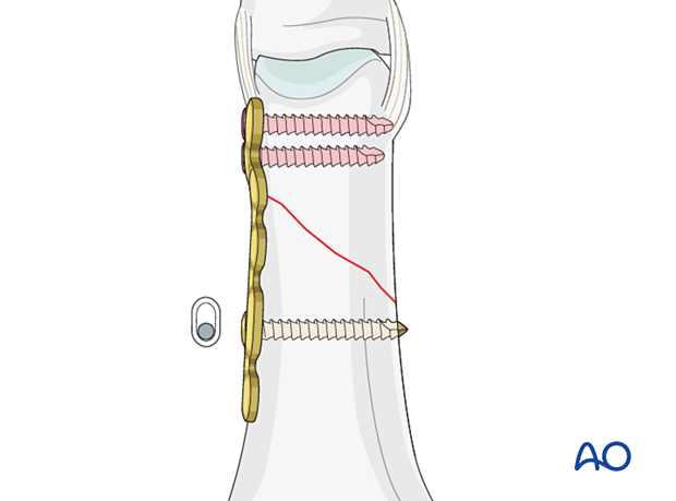 Compression with the plate by screw insertion through oblong hole – extraarticular oblique fracture of the proximal phalangeal head – hand.