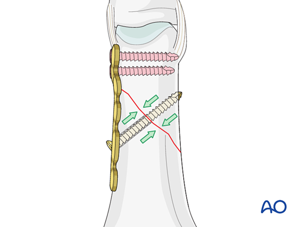 Compression by lag screw insertion through oblong hole – extraarticular oblique fracture of the proximal phalangeal head – hand.