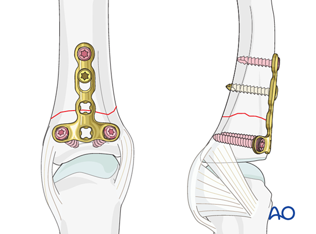 Compression plating with a dorsal T-plate of an extraarticular transverse fracture of the proximal phalangeal base – hand.