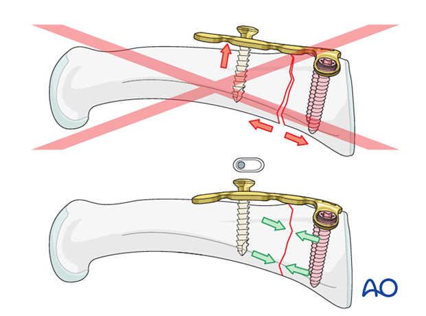 Correct versus incorrect contouring of the dorsal T-plate for an extraarticular transverse fracture of the proximal phalangeal base – hand.