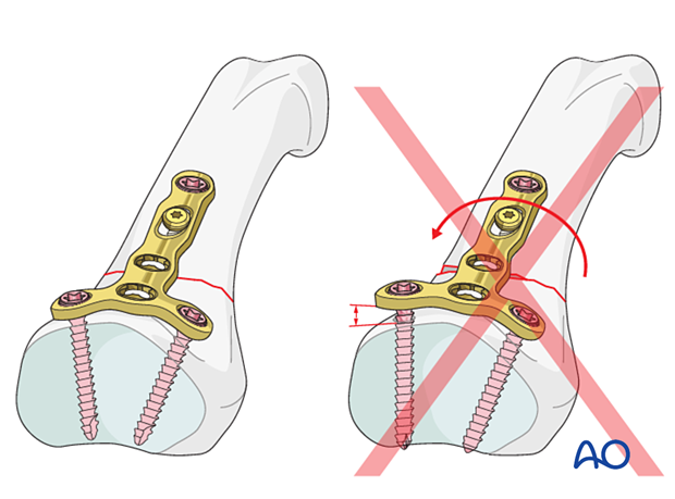 Correct versus incorrect contouring of the dorsal T-plate, checking for perfect adaptation of the plate to the base of the phalanx before screw fixation – extraarticular transverse fracture – hand.