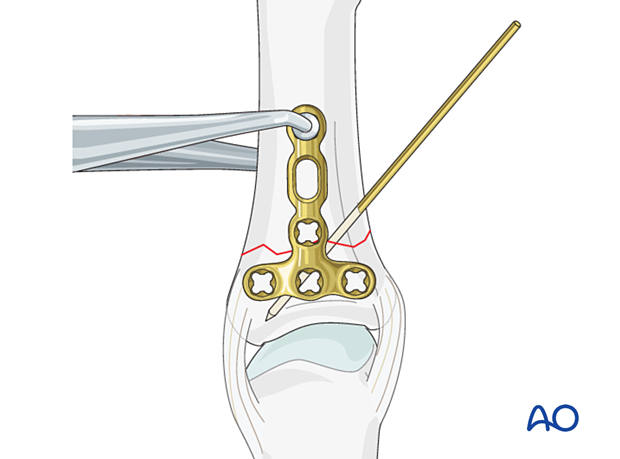 Positioning of the dorsal T-plate for an extraarticular transverse fracture of the proximal phalangeal base – hand.