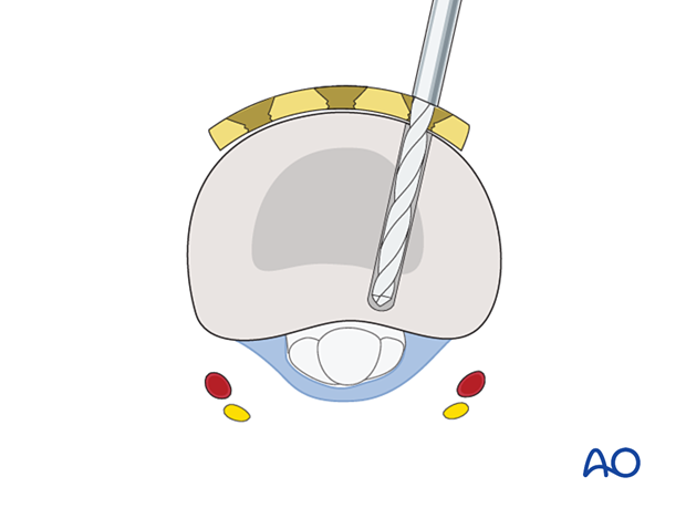 Drilling the hole for proximal screw insertion in a dorsal T-plate for an extraarticular transverse fracture of the proximal phalangeal base – hand.