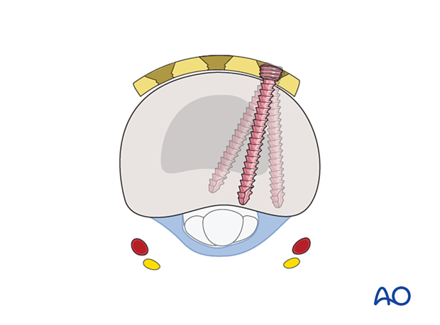 Screw insertion in a dorsal T-plate for an extraarticular transverse fracture of the proximal phalangeal base – hand.