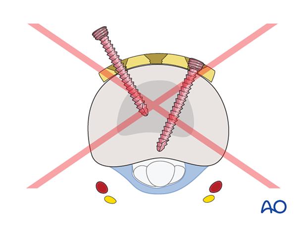 Incorrect screw insertion showing a conflict of the screw tips in a dorsal T-plate for an extraarticular transverse fracture of the proximal phalangeal base – hand.