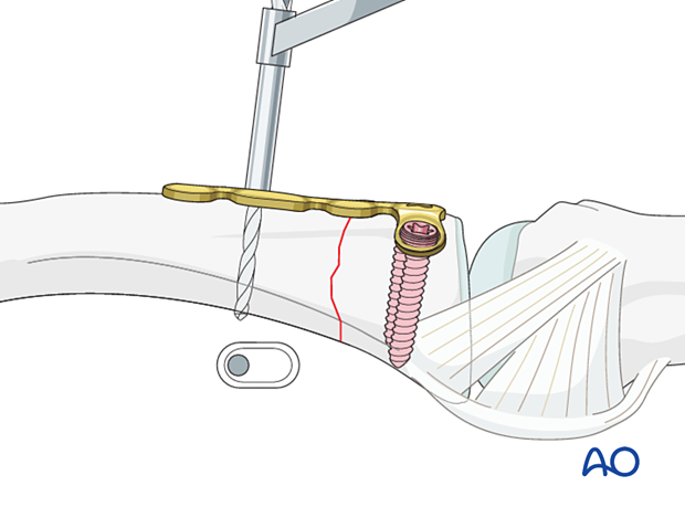 Dorsal plating of a complete articular fracture of the proximal phalangeal base – Drilling for compression screw