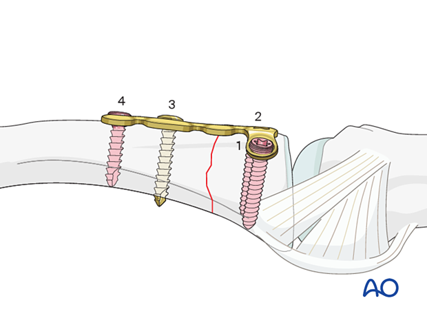 Insertion of more distal diaphyseal locking screw – dorsal T-plate for an extraarticular transverse fracture of the proximal phalangeal base – hand.