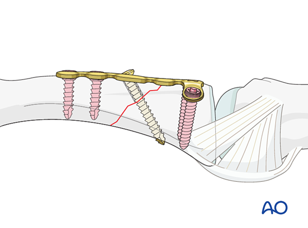 Compression plating with a dorsal T-plate of an extraarticular oblique fracture of the proximal phalangeal base – hand.