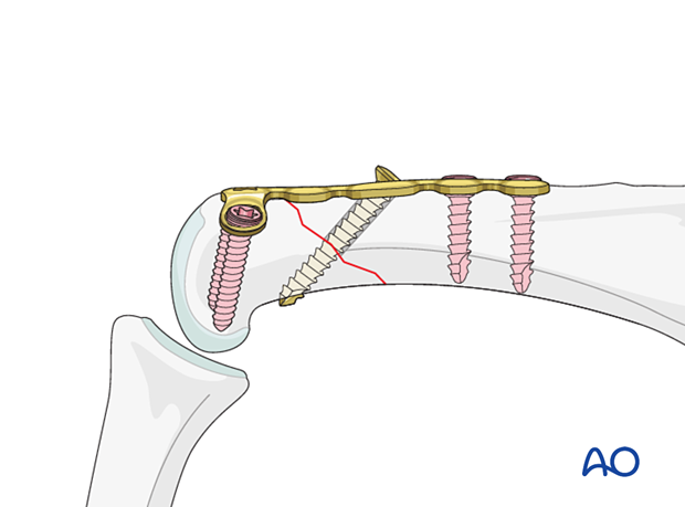 Compression plating with a dorsal T-plate of an extraarticular oblique fracture of the proximal phalangeal head – hand.