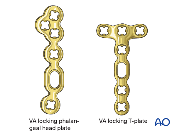 Variable-angle locking phalangeal head plate and a variable-angle locking T-plate.