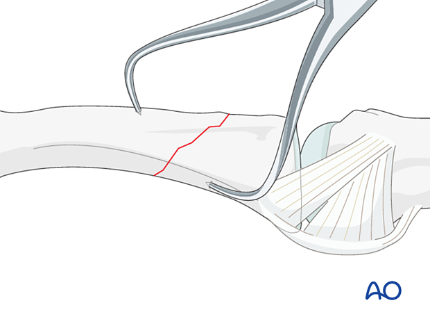 Direct reduction with two pointed-reduction forceps of an extraarticular oblique fracture of the proximal phalangeal base – hand.