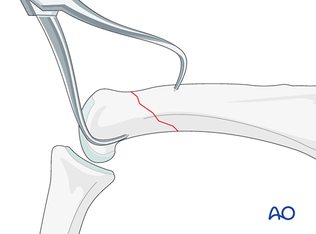 Direct reduction with two pointed-reduction forceps of an extraarticular oblique fracture of the proximal phalangeal head – hand.