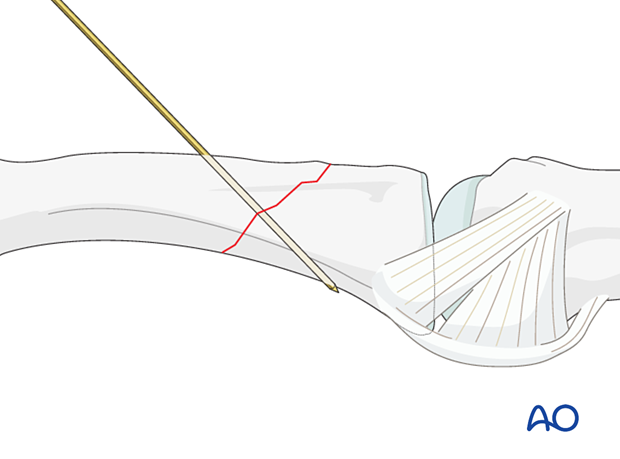 Preliminary fixation with a K-wire of an extraarticular oblique fracture of the proximal phalangeal base – hand.