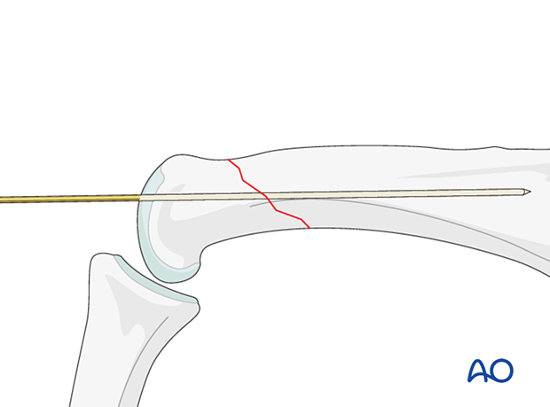 Preliminary fixation with a K-wire of an extraarticular oblique fracture of the proximal phalangeal head – hand.