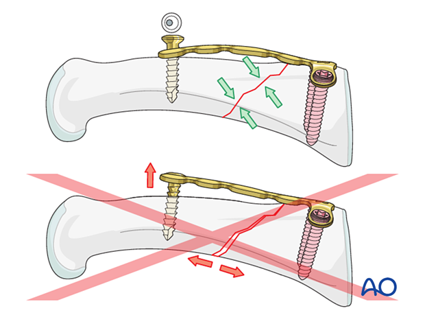 Correct versus incorrect contouring of the dorsal T-plate for an extraarticular oblique fracture of the proximal phalangeal base – hand.