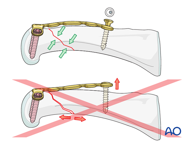 Correct versus incorrect contouring of the dorsal T-plate for an extraarticular oblique fracture of the proximal phalangeal head – hand.