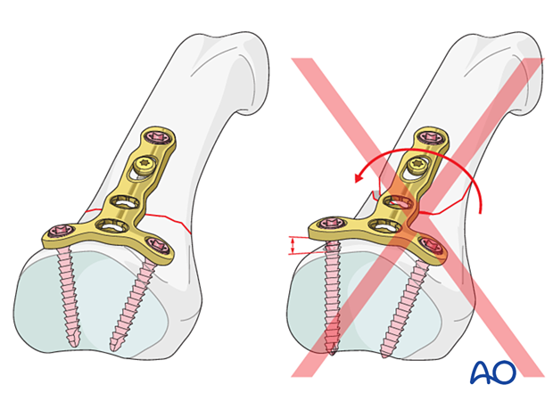 Correct versus incorrect contouring of the dorsal T-plate, checking for perfect adaptation of the plate to the base of the phalanx before screw fixation – extraarticular oblique fracture – hand.