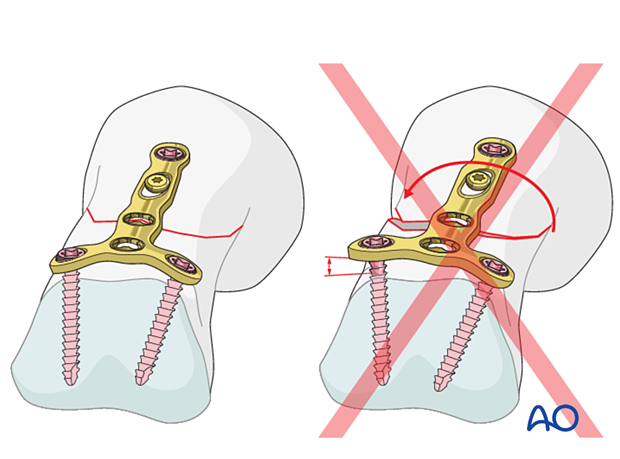 Correct versus incorrect contouring of the dorsal T-plate, checking for perfect adaptation of the plate to the head of the phalanx before screw fixation – extraarticular oblique fracture – hand.