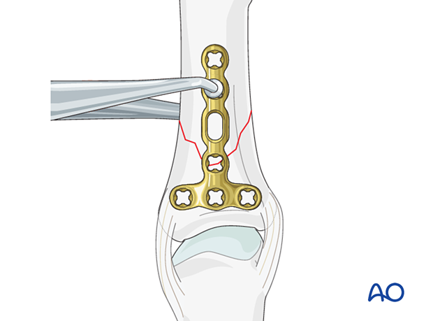 The T-plate is placed dorsally, centered on the diaphysis in the coronal plane – extraarticular oblique fracture of the proximal phalangeal base – hand.