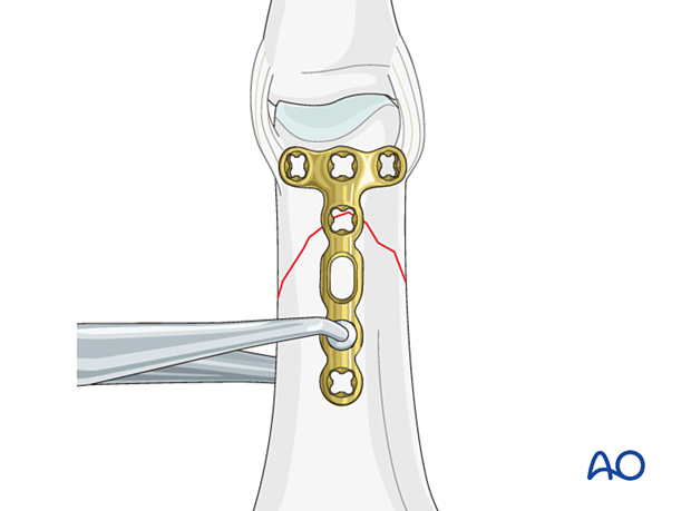 The T-plate is placed dorsally, centered on the diaphysis in the coronal plane – extraarticular oblique fracture of the proximal phalangeal head – hand.