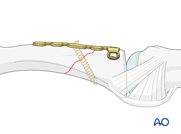 A lag screw inserted through the oblong hole and the middle of the fracture plane as perpendicular as possible to it – extraarticular oblique fracture of the proximal phalangeal base – hand.