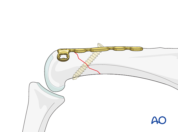 A lag screw inserted through the oblong hole and the middle of the fracture plane as perpendicular as possible to it – extraarticular oblique fracture of the proximal phalangeal head – hand.