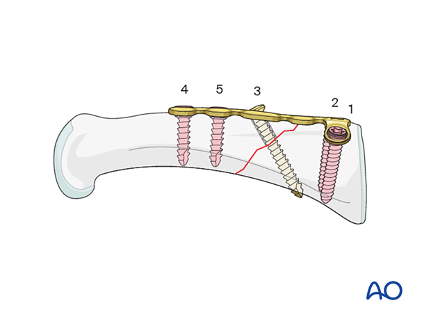 Order and placement of screws – dorsal T-plate for an extraarticular oblique fracture of the proximal phalangeal base – hand.