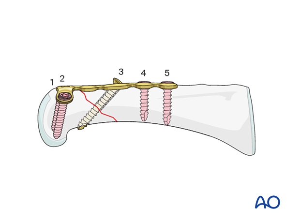 Order and placement of screws – dorsal T-plate for an extraarticular oblique fracture of the proximal phalangeal head – hand.