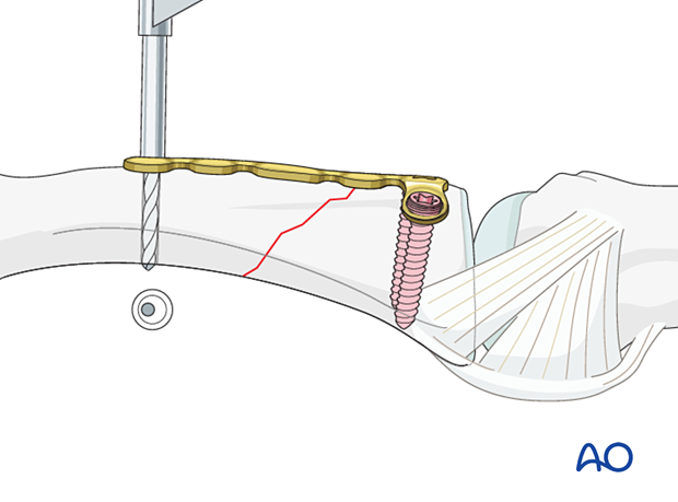 Drilling the hole for the compression screw in the distal hole of the dorsal T-plate for an extraarticular oblique fracture of the proximal phalangeal base – hand.