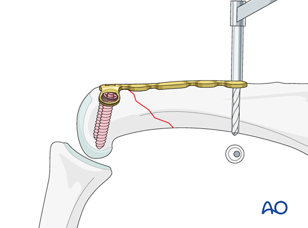 Drilling the hole for the compression screw in the distal hole of the dorsal T-plate for an extraarticular oblique fracture of the proximal phalangeal head – hand.