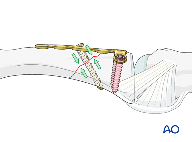 A lag screw inserted through the oblong hole of the dorsal T-plate, perpendicular extraarticular oblique fracture line of the proximal phalangeal base – hand.