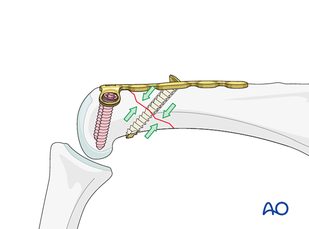 A lag screw inserted through the oblong hole of the dorsal T-plate, perpendicular extraarticular oblique fracture line of the proximal phalangeal head – hand.