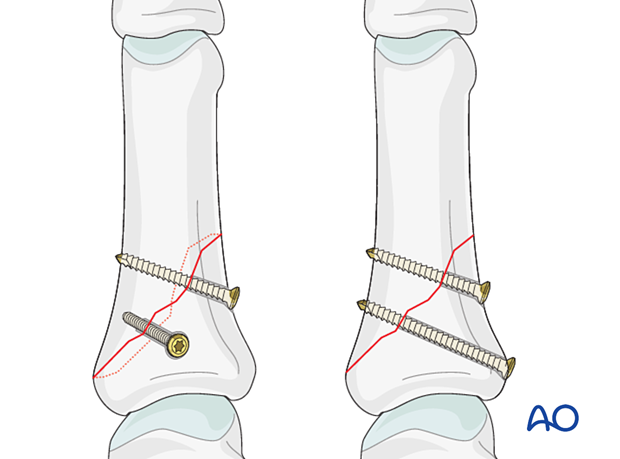 Lag screw fixation with two or more screws of long oblique and spiral proximal phalangeal hand fracture