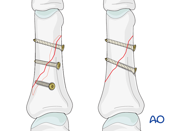 Lag screw fixation with two or more screws of long oblique and spiral diaphyseal phalangeal hand fracture