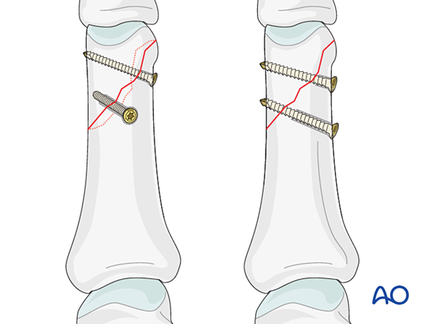 Lag screw fixation with two or more screws of long oblique and spiral distal phalangeal hand fracture