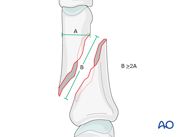 Model to determine screw placement of interfragmentary screws for long oblique and spiral phalangeal hand fracture