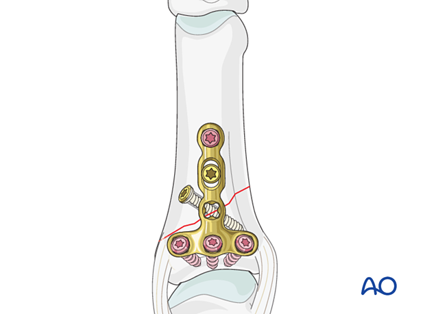 An oblique proximal phalangeal hand fracture stabilized with a lag screw and protected by a neutralization plate.