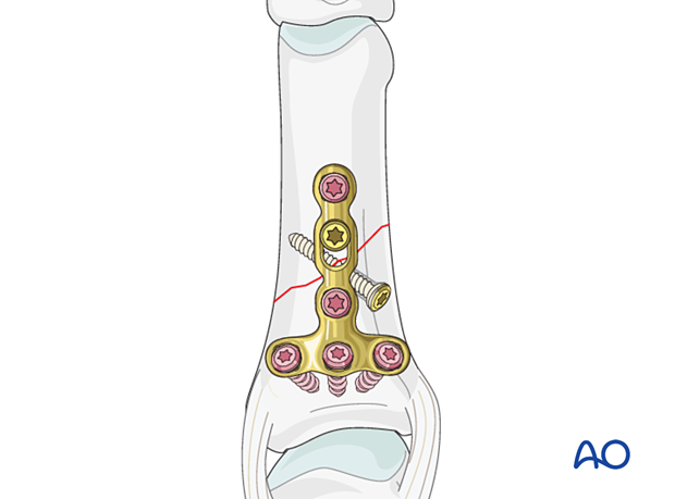 An oblique diaphyseal phalangeal hand fracture stabilized with a lag screw and protected by a neutralization plate.