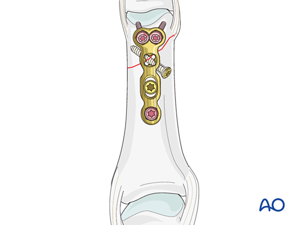 An oblique distal phalangeal hand fracture stabilized with a lag screw and protected by a neutralization plate.