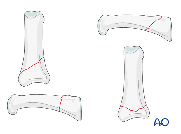 AP and lateral views of oblique extraarticular fractures of the proximal phalanx - hand