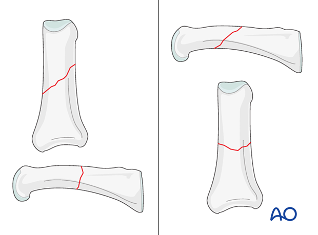 AP and lateral views of oblique extraarticular fractures of the diaphyseal phalanx - hand