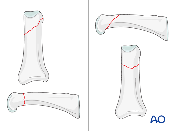 AP and lateral views of oblique extraarticular fractures of the distal phalanx - hand